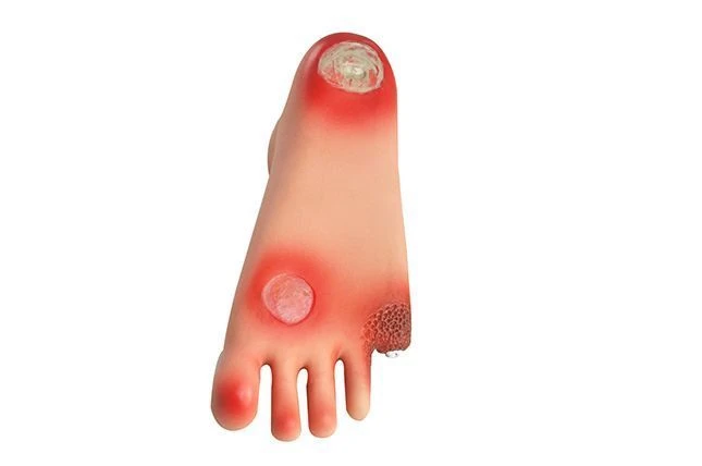 Diabetic Foot Model, 19
