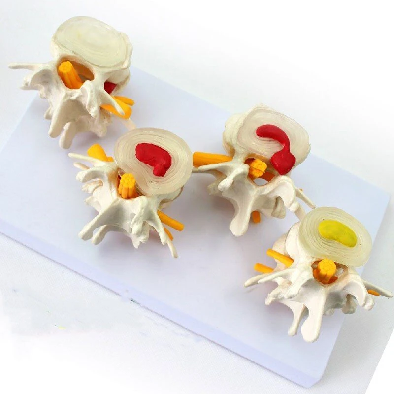 نموذج تشريحي لعلم أمراض العمود الفقري، 11208