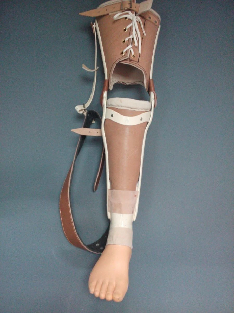Non-modular below-knee prosthesis for congenital underdevelopment