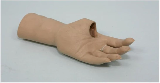 Cosmetic Hand Prosthesis for Partial and Complete Hand Amputation