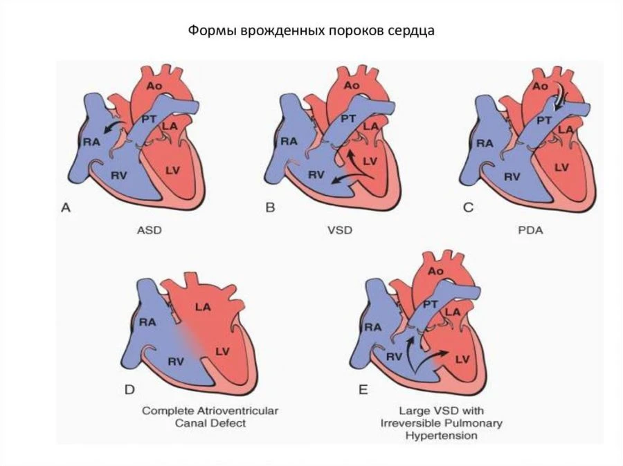 Congenital Heart Defects Model Set, 16016