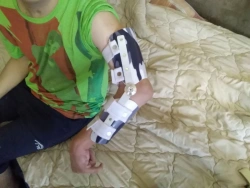 Orthopedic Elbow Joint Devices