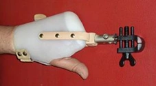 Functional Hand Prosthesis for Partial Hand Amputation