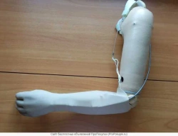 Active Shoulder Prosthesis - Right/Left Model