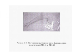 Electromechanical Shoulder Prosthesis with Control System PR8-VIE-01