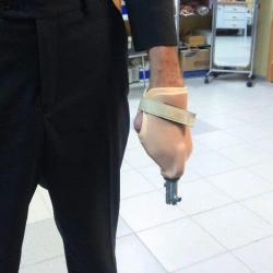 Functional Prosthetic Hand for All Age Groups