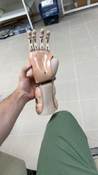 Active Hand Prosthesis (Traction) for Partial and Complete Amputation