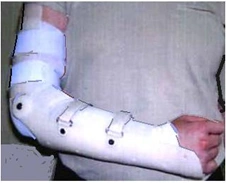 Wrist and Elbow Joint Treatment Device