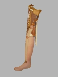 Non-Modular Hip Prosthesis for Patients with Irregular Stumps